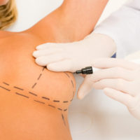 Plastic surgery doctor draw line on patient breast augmentation implant